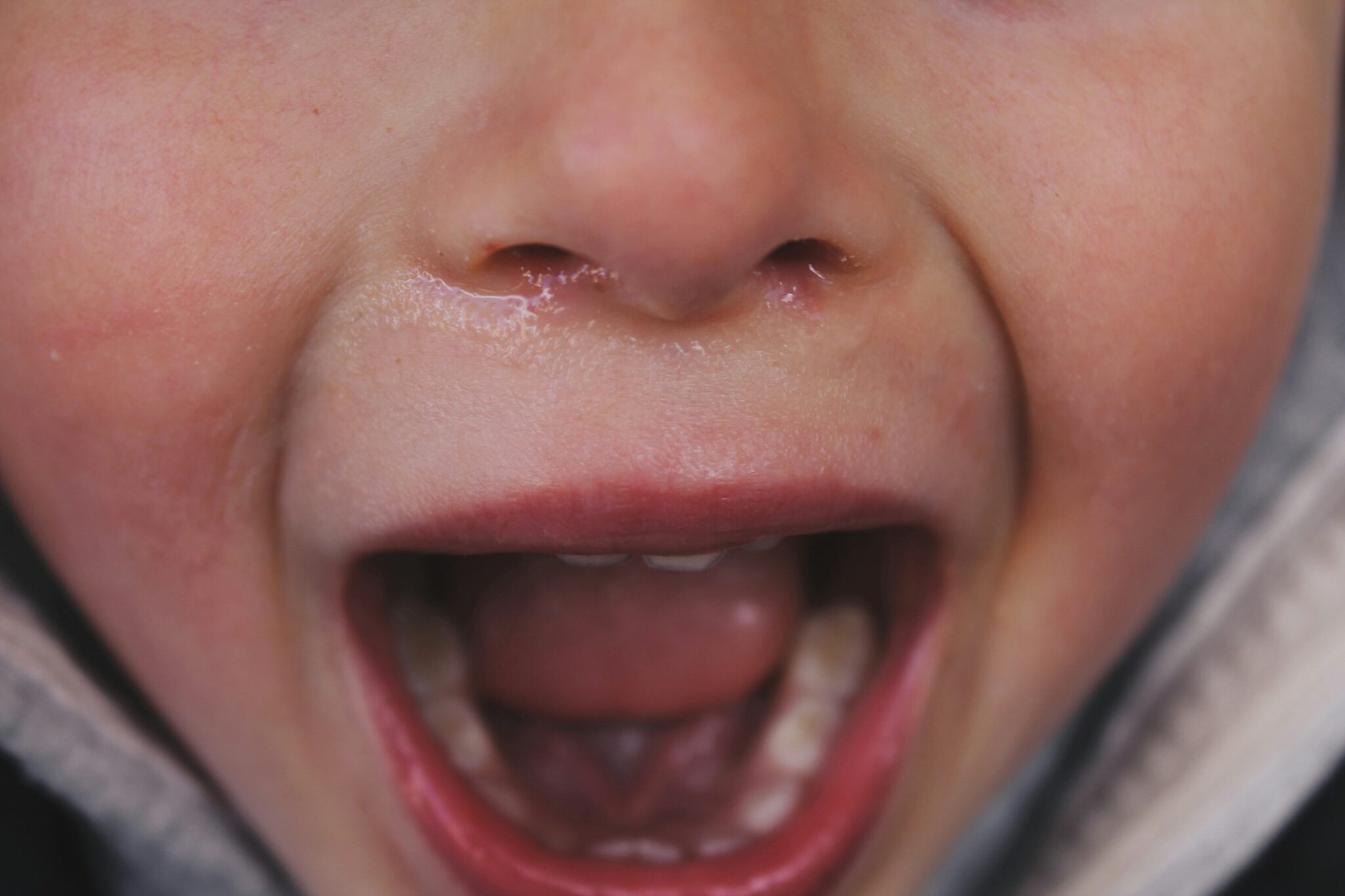 Pediatric Dentistry Mystery: What causes cracked teeth in children?